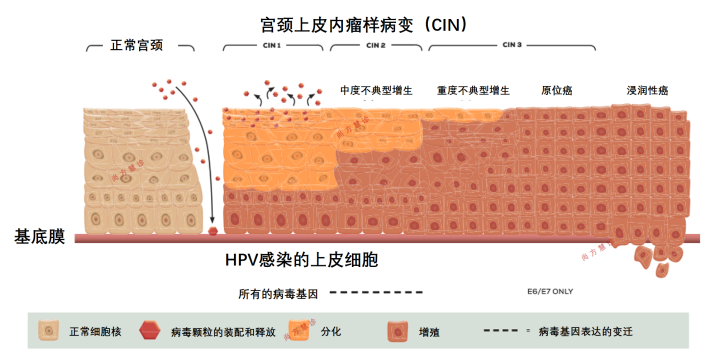 宮頸癌是怎樣一步步形成的？